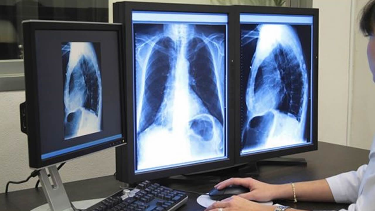 Cáncer de pulmón, el más letal en hombres Cáncer de pulmón, el más letal en hombres