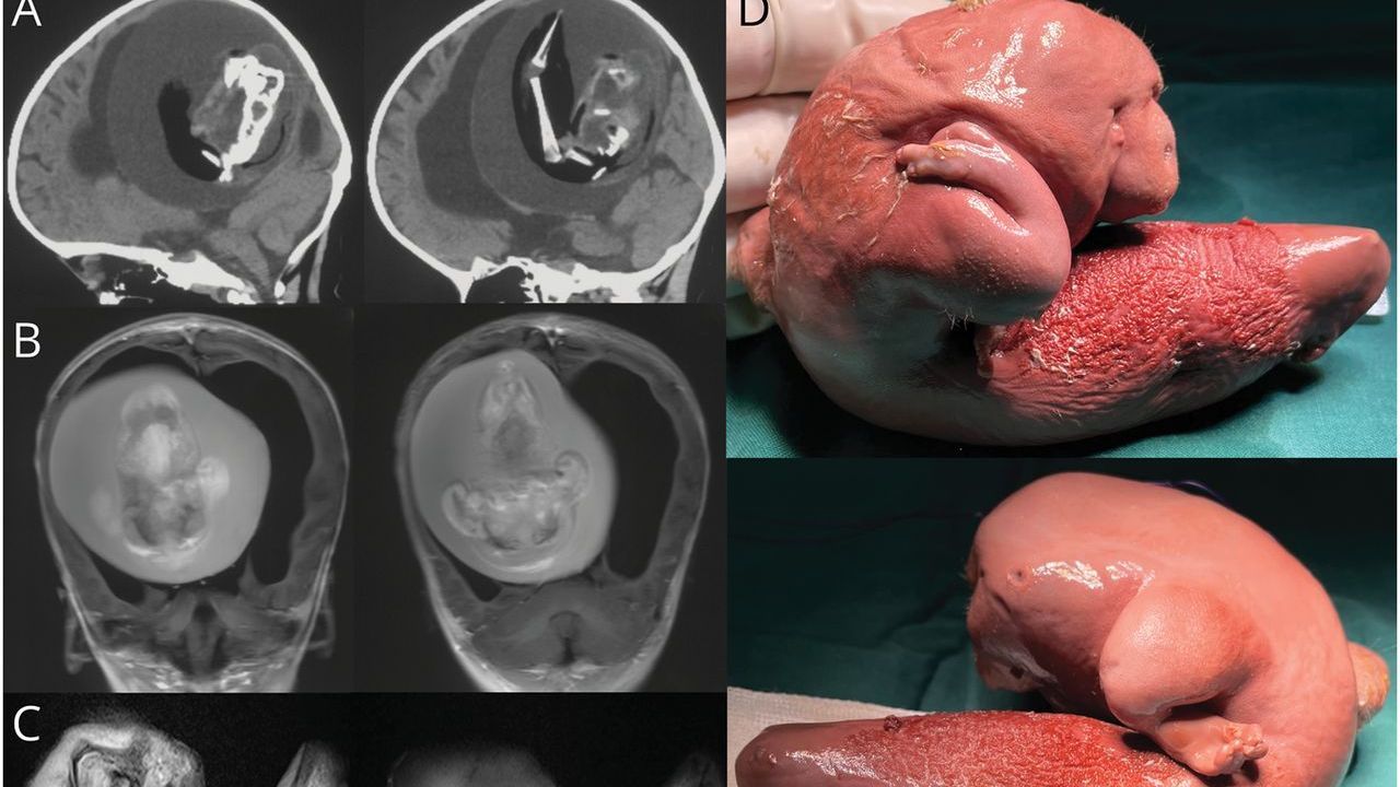 Una incisi�n de 8 cent�metros y una recuperaci�n r�pida: as� es el primer trasplante de pulmones robotizado.El investigador gallego Luis Paz Ares