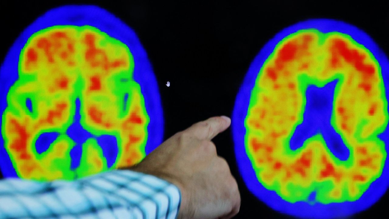 Una incisi�n de 8 cent�metros y una recuperaci�n r�pida: as� es el primer trasplante de pulmones robotizado.Banco de pelucas para la Asociaci�n contra el C�ncer
