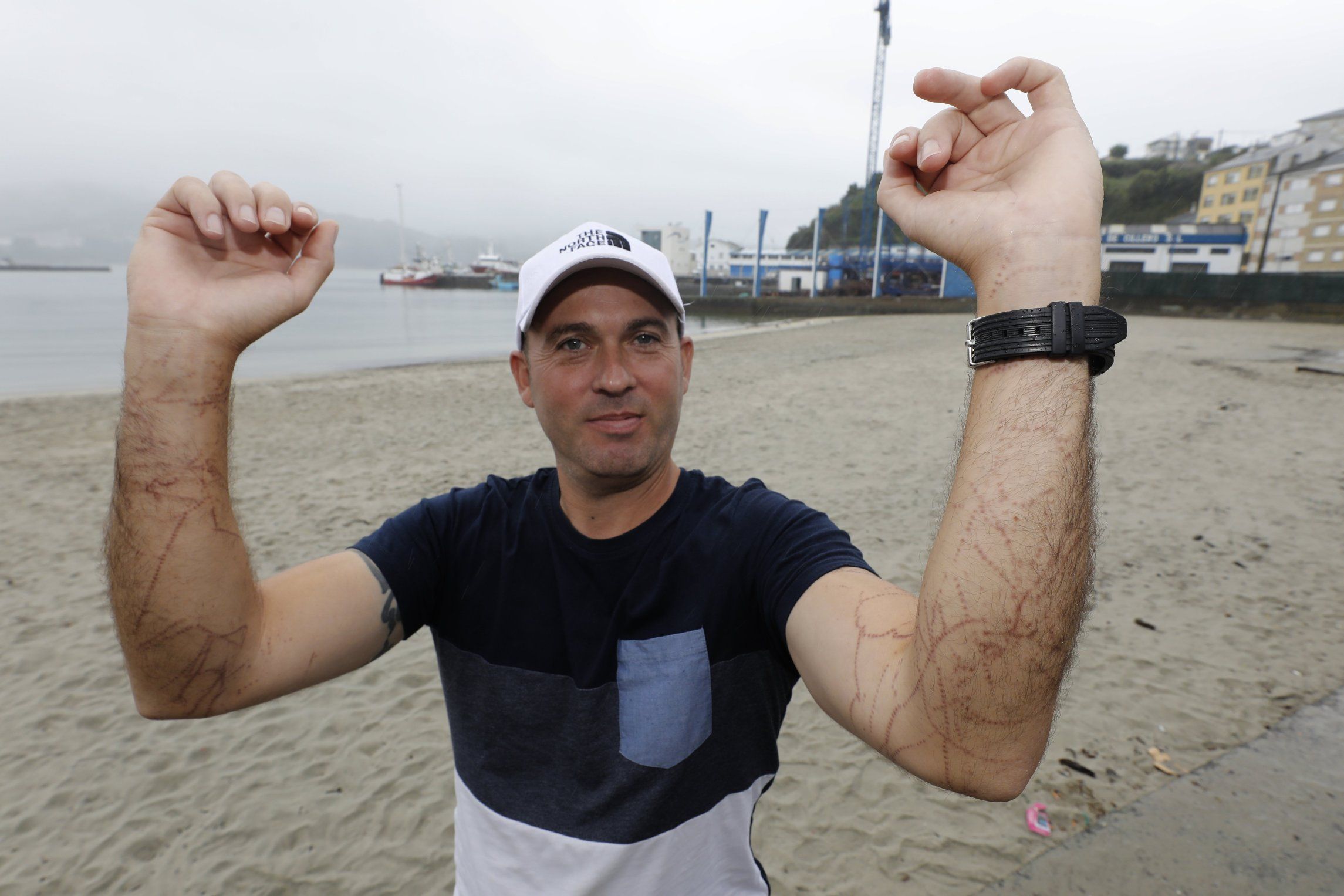 Roberto mostra as feridas causadas por unha carabela portuguesa mentras nadaba na zona de Abrela, no Vicedo. 29/09/2024