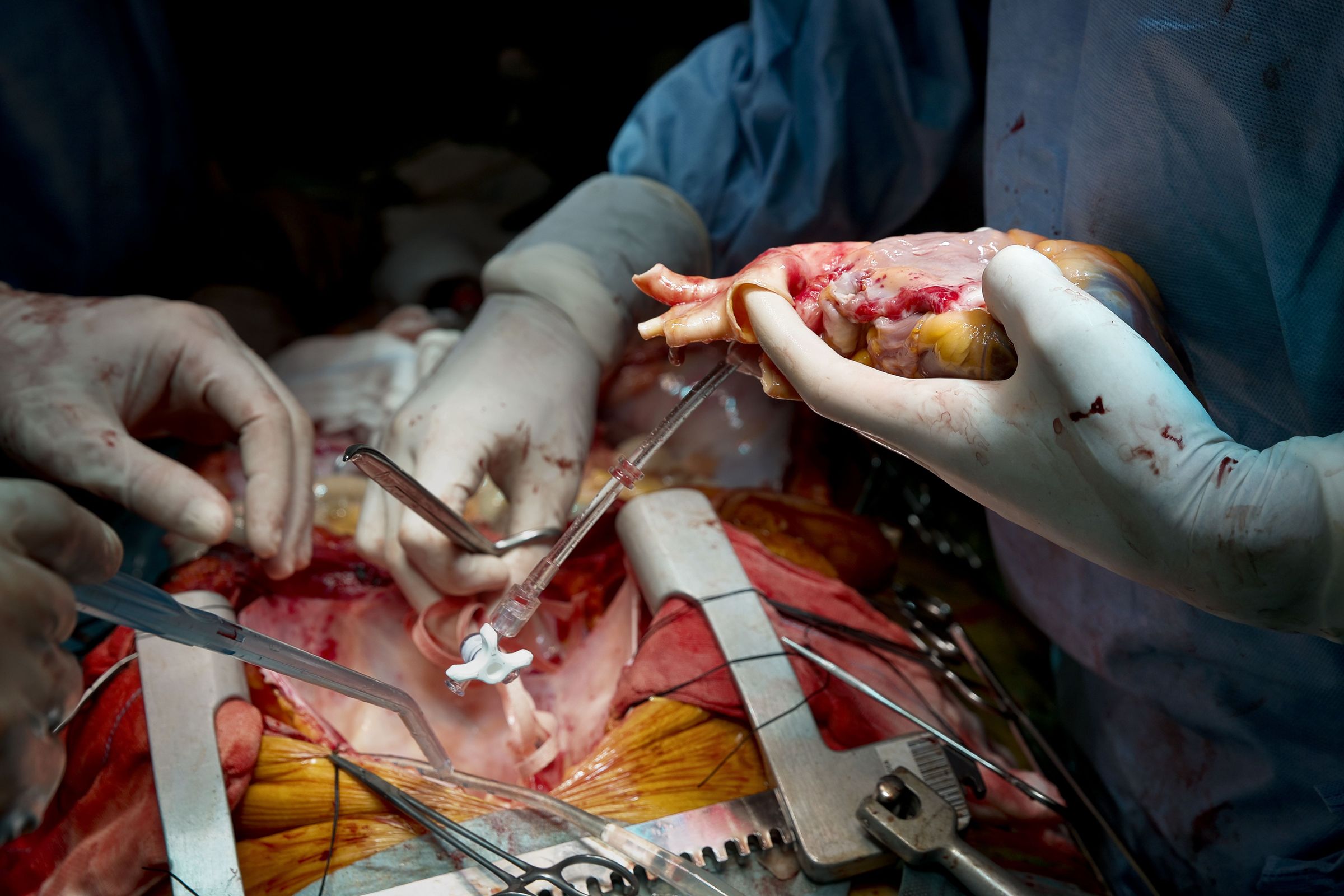 Trasplante de corazn. Momento da extraccin, minutos antes de ser implantado no peito do receptor.