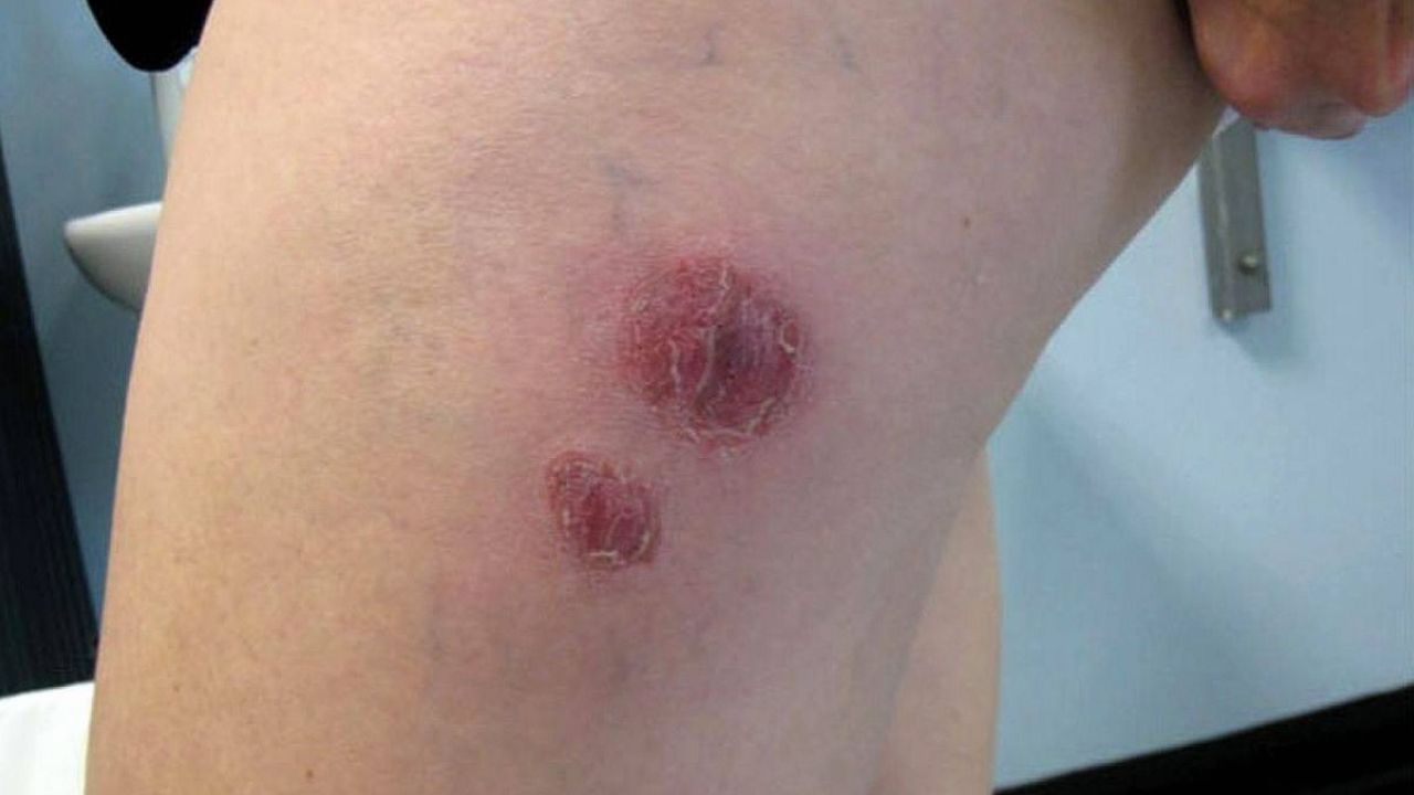 Piel infectada por la bacteria